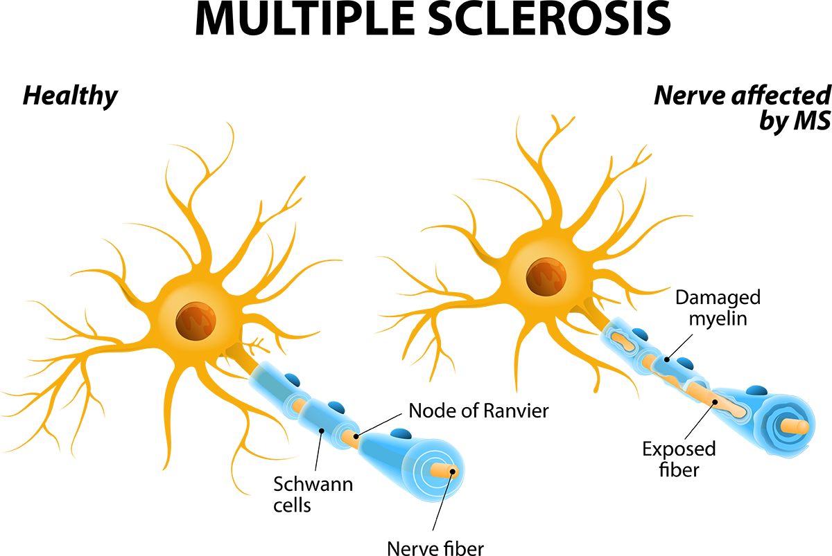 multiple sclerosis nerve comparison illustration; blog: early warning signs of multiple sclerosis