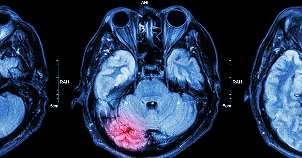 Close up of MRI brain : Lower part of brain ( eyes , temporal lobe of cerebrum , cerebellum , brain stem); blog: 6 Things to Know About Brain Injuries